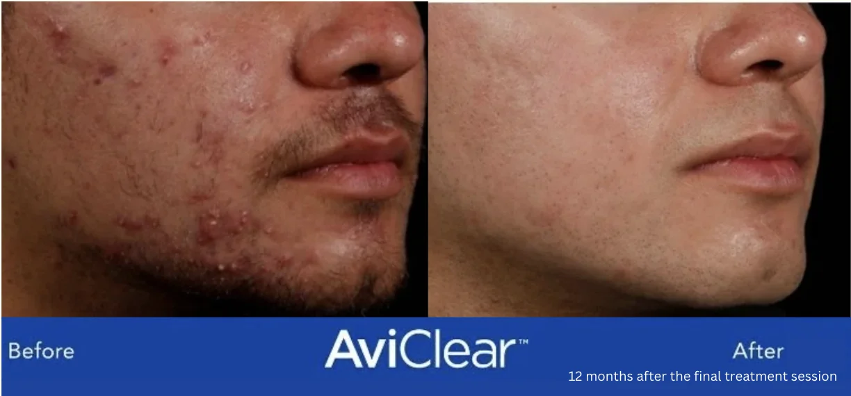 Before and After of Avi Clear Acne Treatments